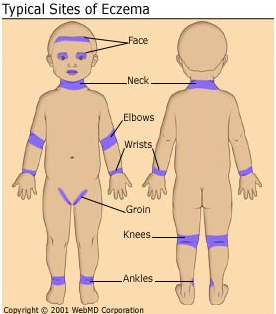 typical sites of eczema